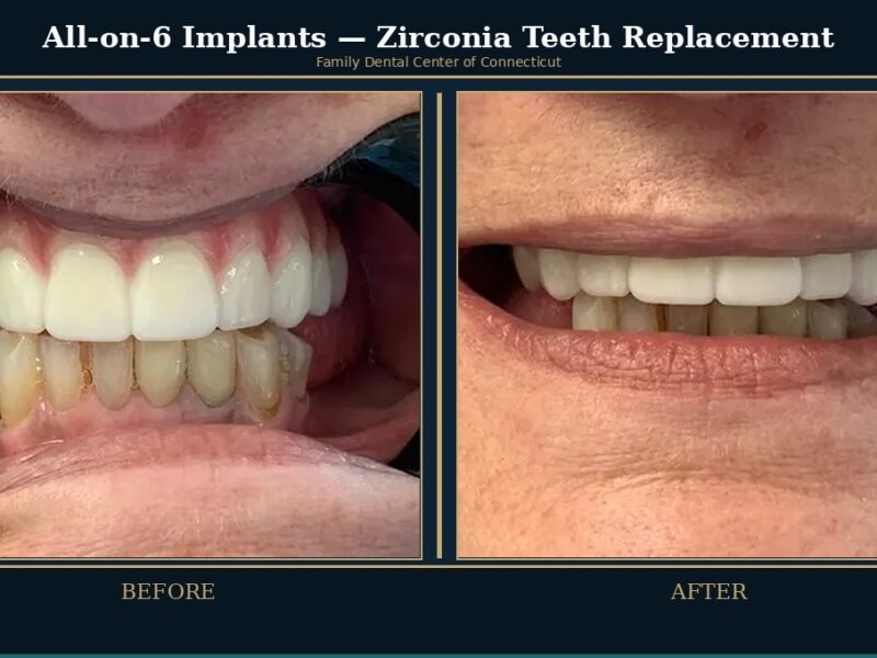 all-on-6-zirconia