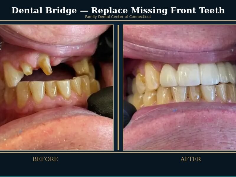 dental-bridge