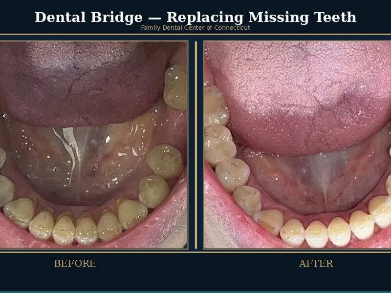 dental-bridge-missing-teeth