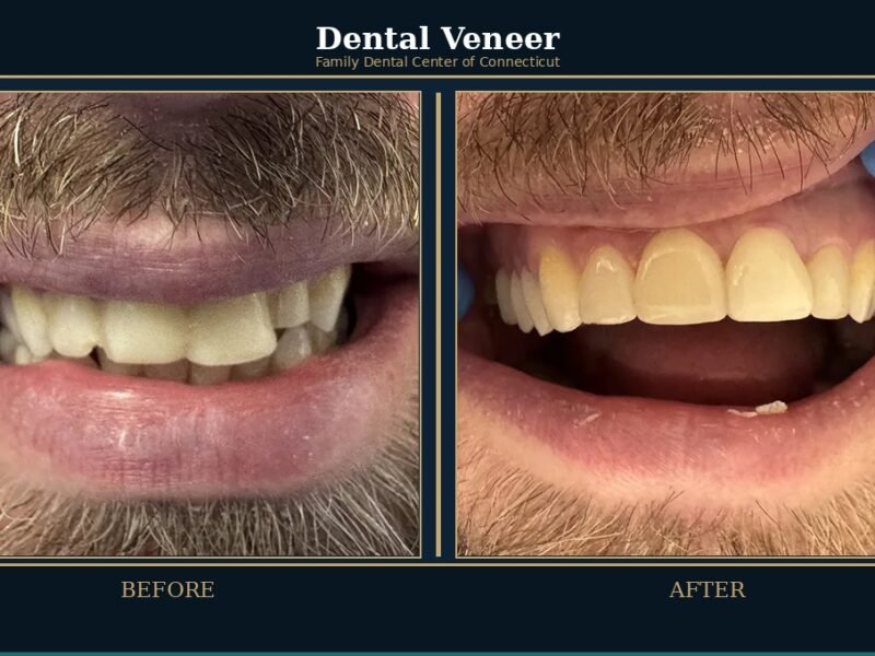 dental-veneer