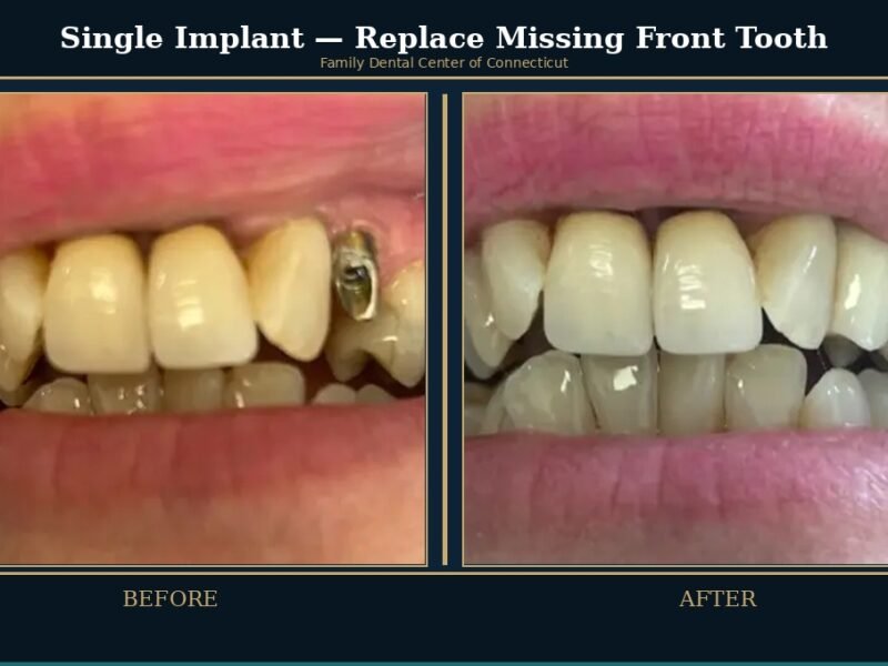 front-tooth-single-implant
