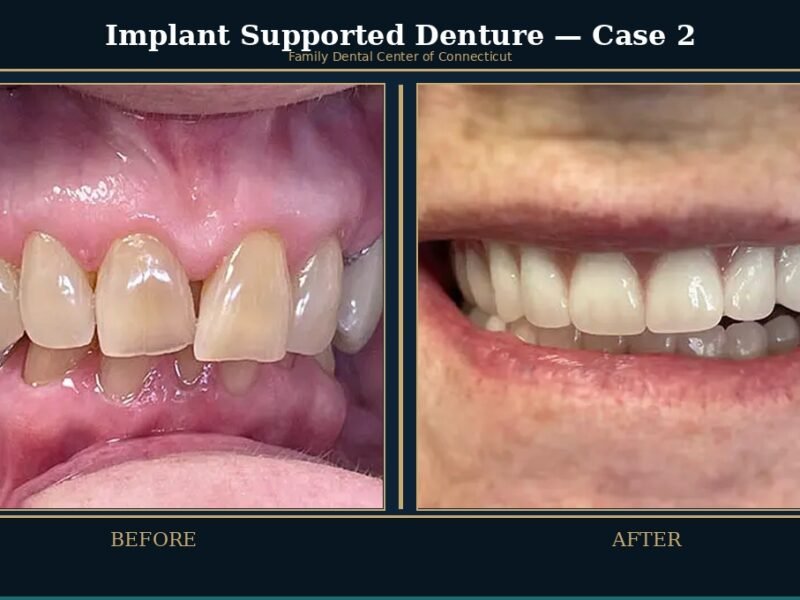 implant-supported-denture-2