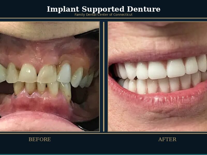 implant-supported-denture