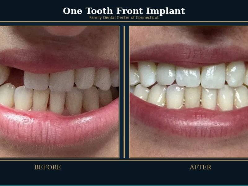 one-tooth-front-implant