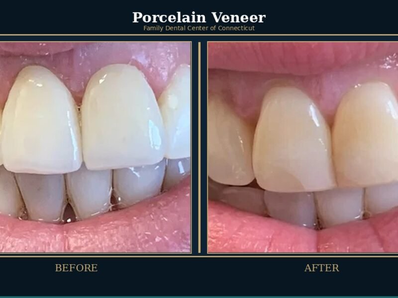 porcelain-veneer