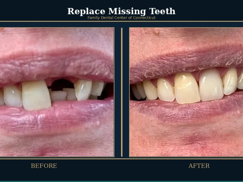 replace-missing-teeth