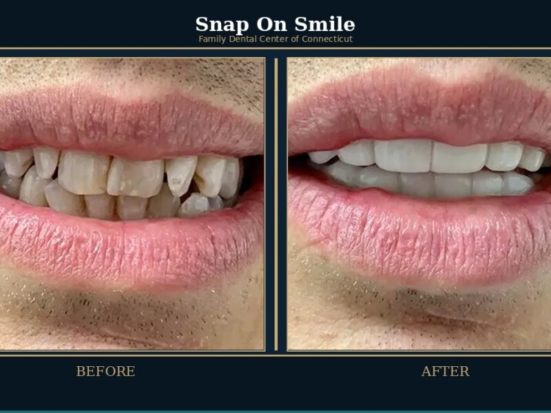 snap-on-smile