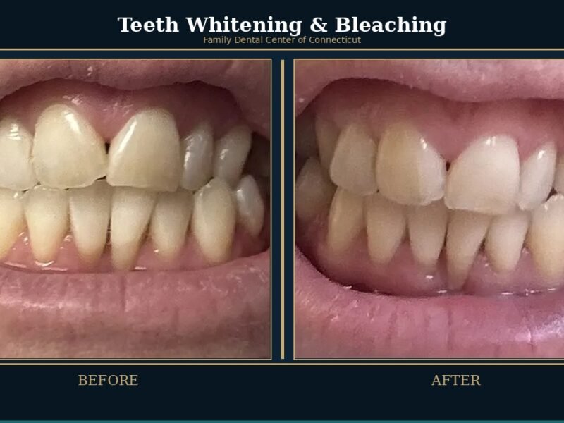 teeth-whitening